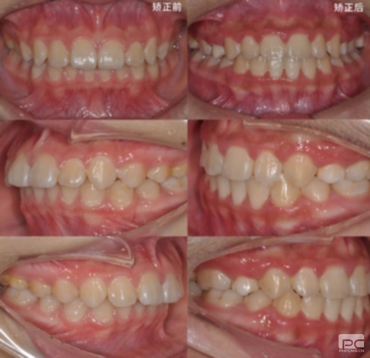 齙牙正畸牙齒后臉型變化圖,成人矯正牙齒臉型變化圖,整牙后臉型變化 齙牙正畸牙齒后臉型變化圖,成人矯正牙齒臉型變化圖,整牙后臉型變化