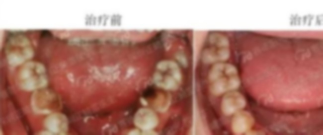 拔牙后嘴里血塊要吐掉嗎?的血塊能吐嗎?的血塊可以吐嗎? 拔牙后嘴里血塊要吐掉嗎?的血塊能吐嗎?的血塊可以吐嗎?