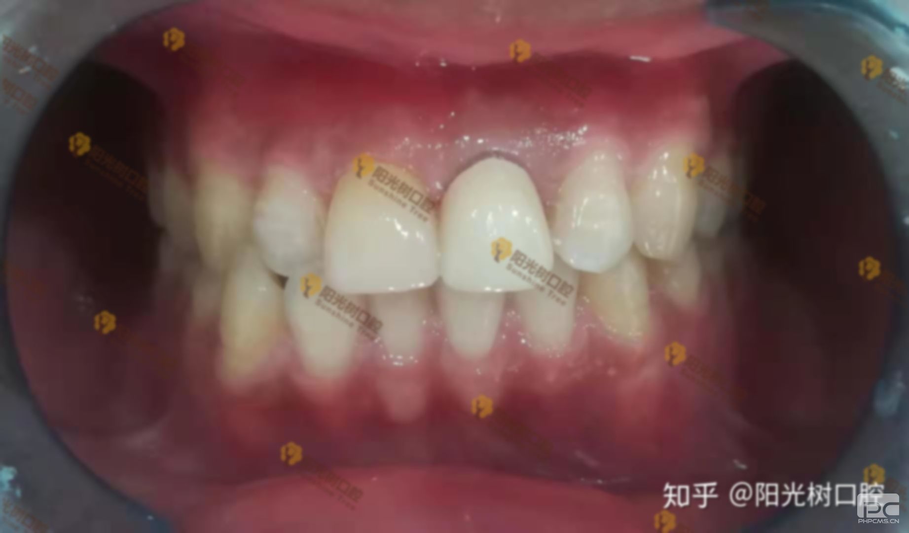 拔牙多久才能做烤瓷牙,拔完牙多久才能做烤瓷牙,能做烤瓷牙 拔牙多久才能做烤瓷牙,拔完牙多久才能做烤瓷牙,能做烤瓷牙