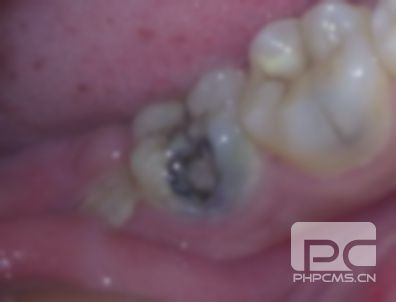 在醫(yī)院拔個(gè)牙要多少錢?現(xiàn)在拔個(gè)牙要多少錢?現(xiàn)在拔個(gè)牙需要多少錢? 在醫(yī)院拔個(gè)牙要多少錢?現(xiàn)在拔個(gè)牙要多少錢?現(xiàn)在拔個(gè)牙需要多少錢?
