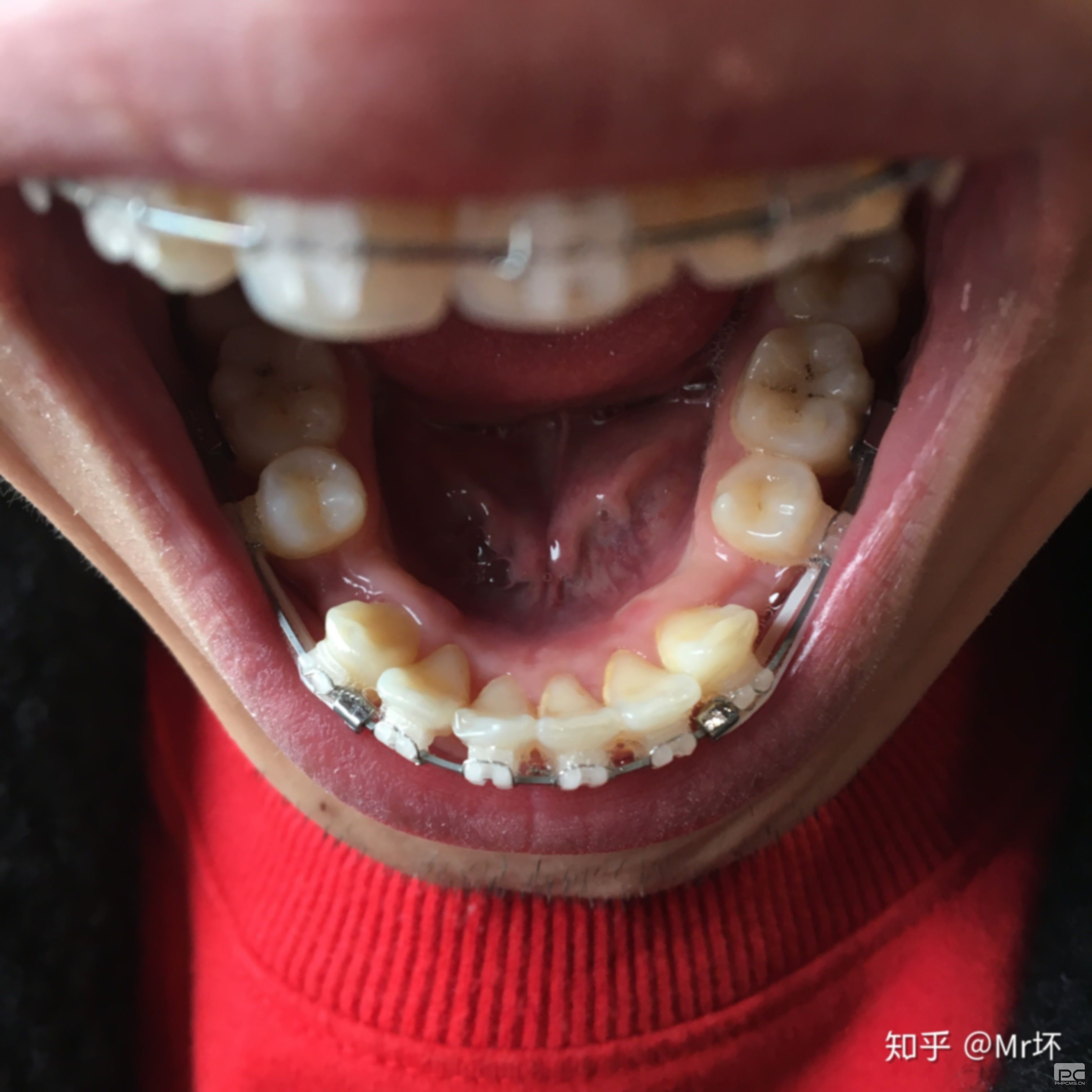 怎么解決齙牙?怎樣解決齙牙?如何解決齙牙 怎么解決齙牙?怎樣解決齙牙?如何解決齙牙
