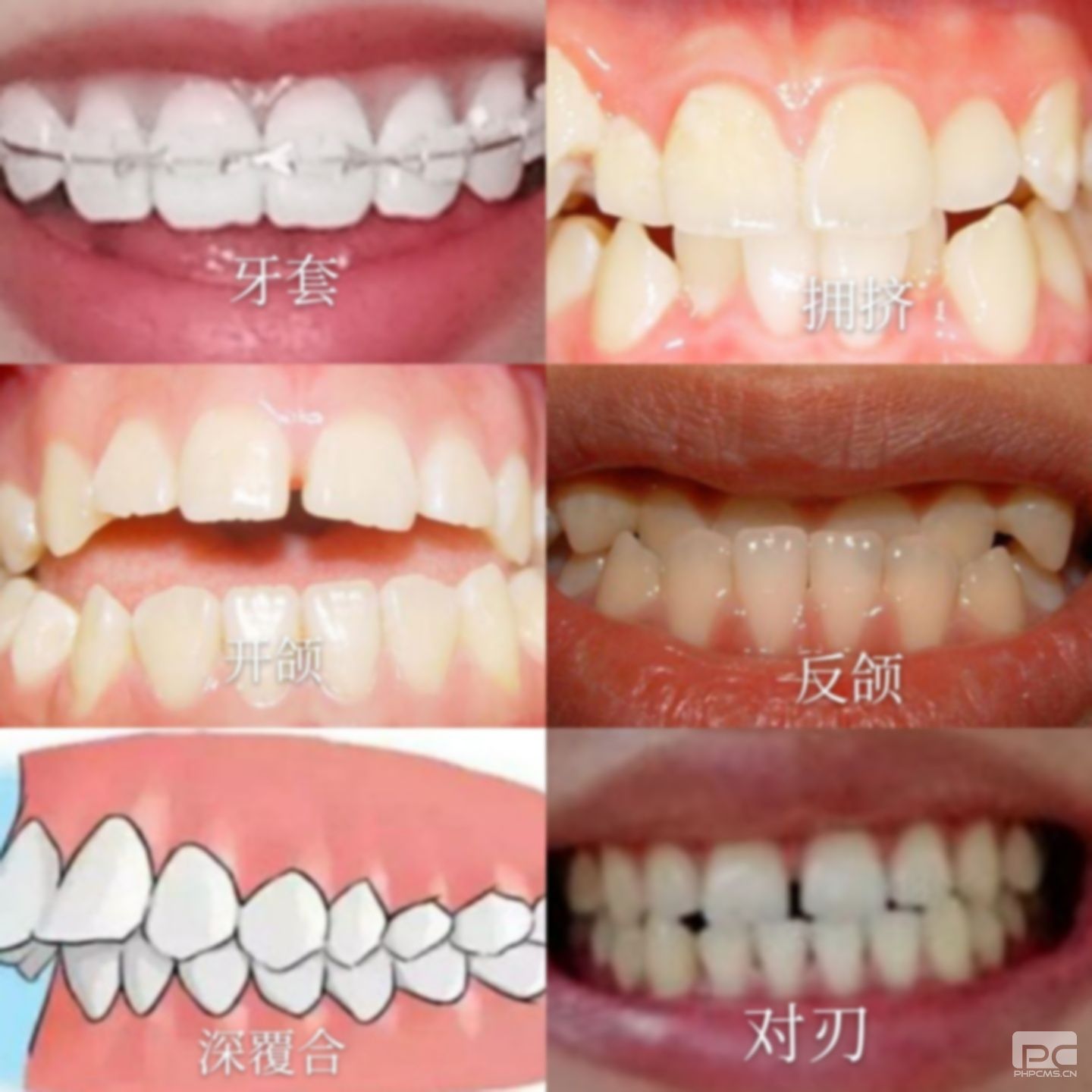 牙齒矯正什么年齡最佳?最大年齡,最佳年齡段 牙齒矯正什么年齡最佳?最大年齡,最佳年齡段