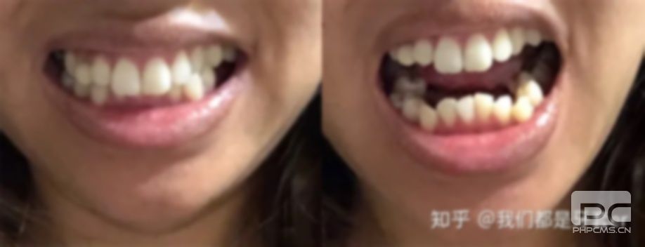 30歲整牙的危害,后悔,還有整牙的必要嗎? 30歲整牙的危害,后悔,還有整牙的必要嗎?