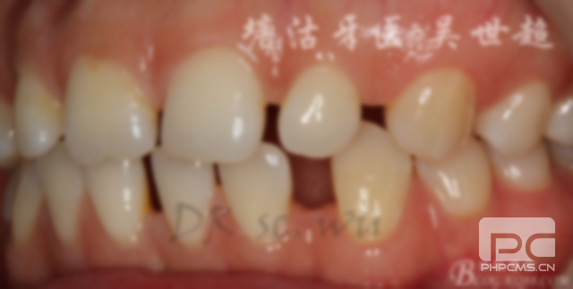 烤瓷牙能做瓷貼面嗎?齙牙可以做瓷貼面嗎?全瓷牙可以做牙貼面嗎? 烤瓷牙能做瓷貼面嗎?齙牙可以做瓷貼面嗎?全瓷牙可以做牙貼面嗎?