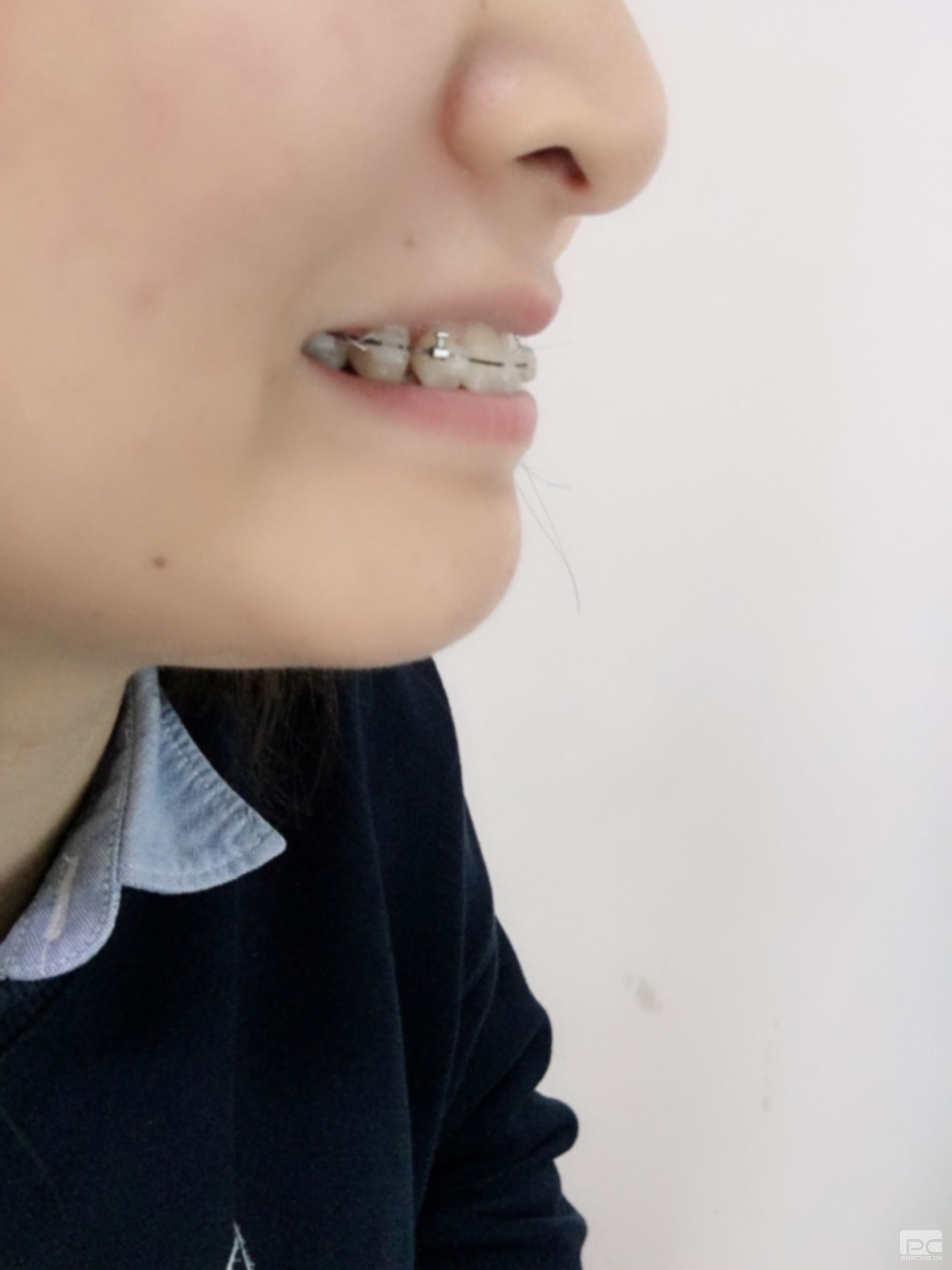 九歲小孩戴牙套矯正要多少錢(qián)?18歲戴牙套要多少錢(qián)?29歲戴牙套要多少費(fèi)用?
