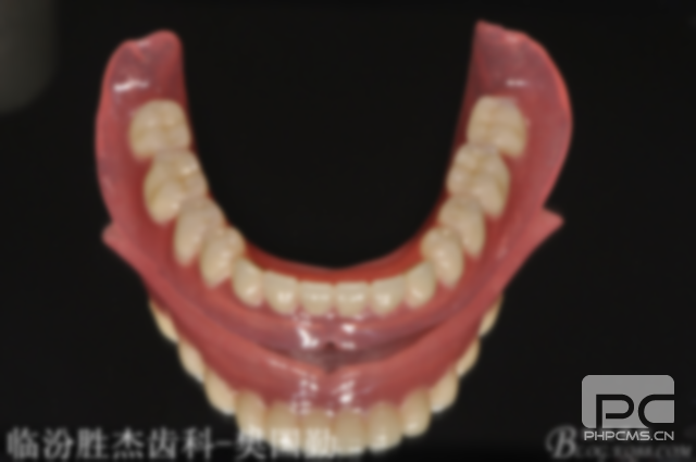 半口活動(dòng)假牙用什么材料好?好用嗎?怎么固定? 半口活動(dòng)假牙用什么材料好?好用嗎?怎么固定?