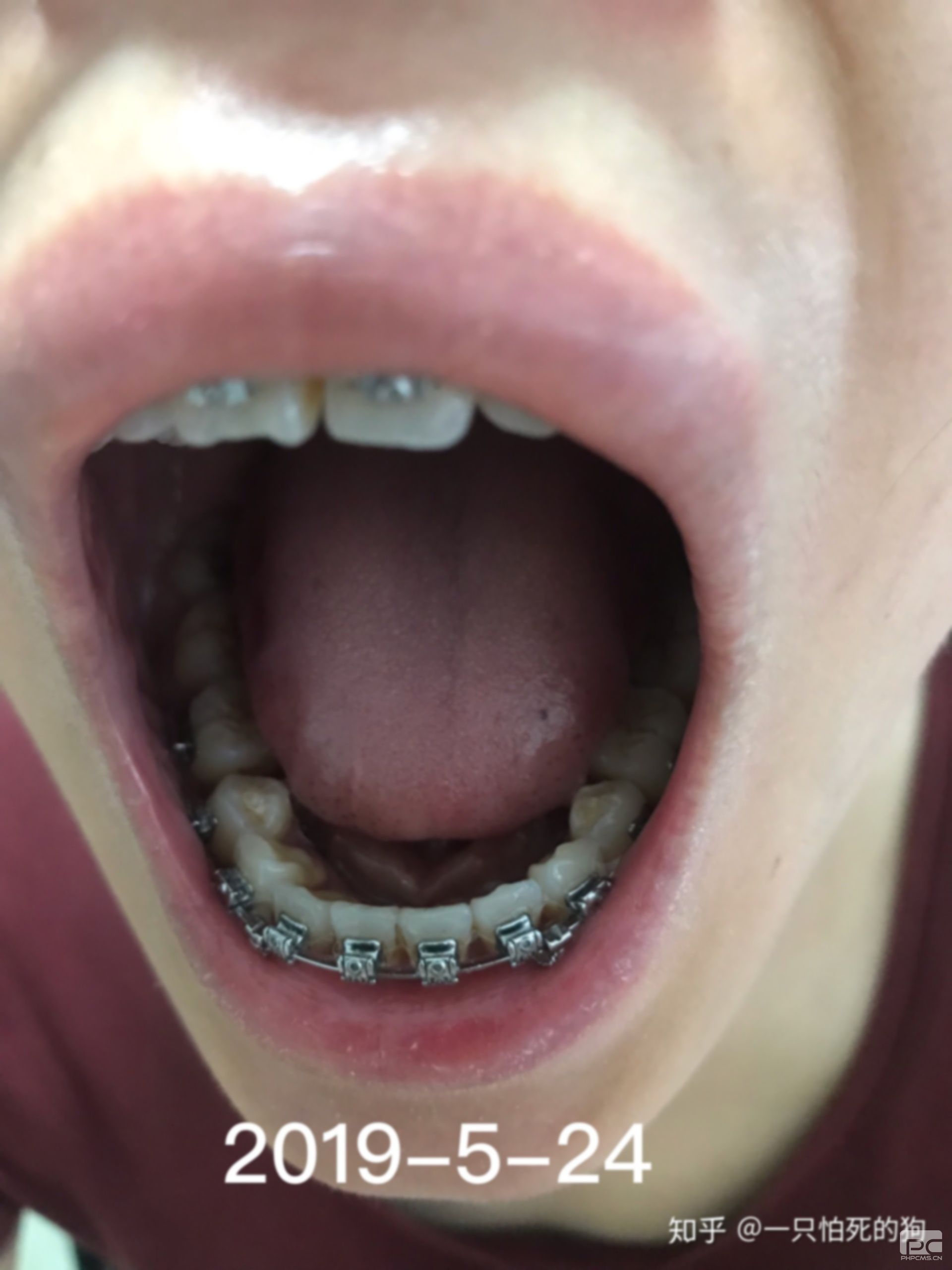 35歲整牙齒有效果嗎?齙牙還有效果不,牙有什么危害嗎? 35歲整牙齒有效果嗎?齙牙還有效果不,牙有什么危害嗎?