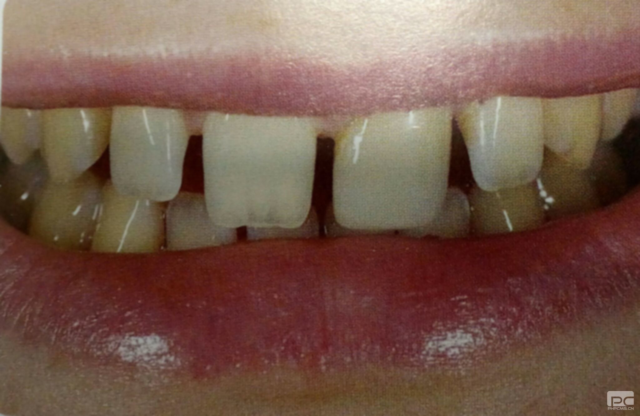 7歲孩子門牙有縫怎么辦?縫隙大怎么辦?小孩門牙有縫怎么辦? 7歲孩子門牙有縫怎么辦?縫隙大怎么辦?小孩門牙有縫怎么辦?