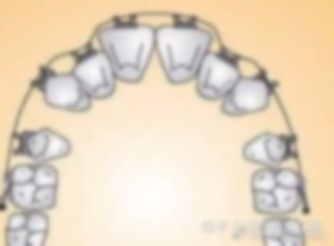 正畸拔4號牙會(huì)不會(huì)臉?biāo)?拔了4號牙臉會(huì)塌陷嗎?拔4號牙臉?biāo)? title=