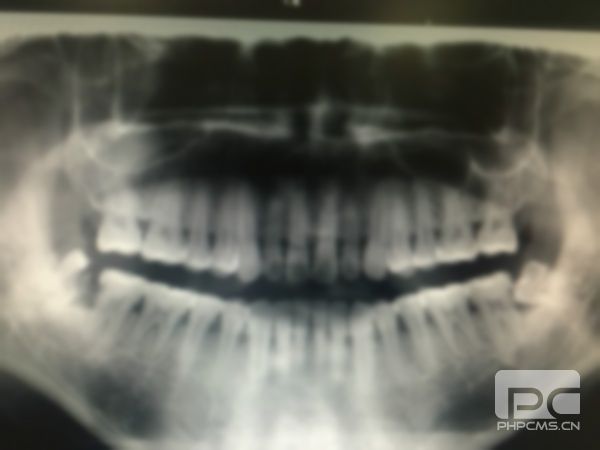 牙醫(yī)讓拔智齒,拔智齒賺錢嗎?被牙醫(yī)忽悠拔了智齒 牙醫(yī)讓拔智齒,拔智齒賺錢嗎?被牙醫(yī)忽悠拔了智齒