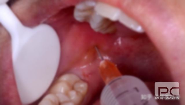 小孩拔牙要多少錢?兒童拔牙要多少錢?一般拔牙要多少錢? 小孩拔牙要多少錢?兒童拔牙要多少錢?一般拔牙要多少錢?