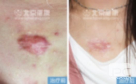 凸出疤痕創(chuàng)可貼貼有用嗎?疤痕貼對(duì)新疤痕有用嗎?疤痕貼有效果嗎?