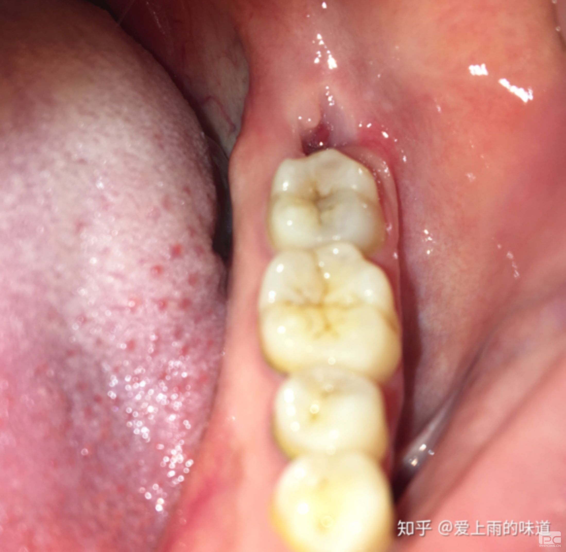 拔完智齒后洞里面有白色的東西什么時(shí)候會沒?是什么?怎么辦? 拔完智齒后洞里面有白色的東西什么時(shí)候會沒?是什么?怎么辦?