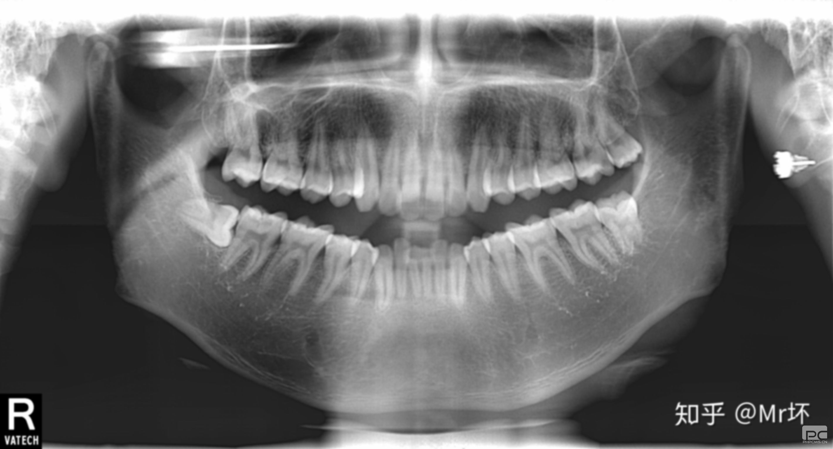 八歲矯正牙齒可以嗎?的孩子能矯正牙齒嗎?8歲牙齒可以矯正嗎? 八歲矯正牙齒可以嗎?的孩子能矯正牙齒嗎?8歲牙齒可以矯正嗎?