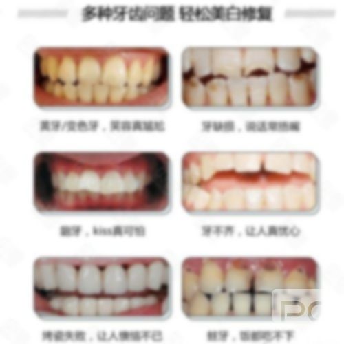 愛爾創(chuàng)全瓷牙1000元,800元,1500 愛爾創(chuàng)全瓷牙1000元,800元,1500
