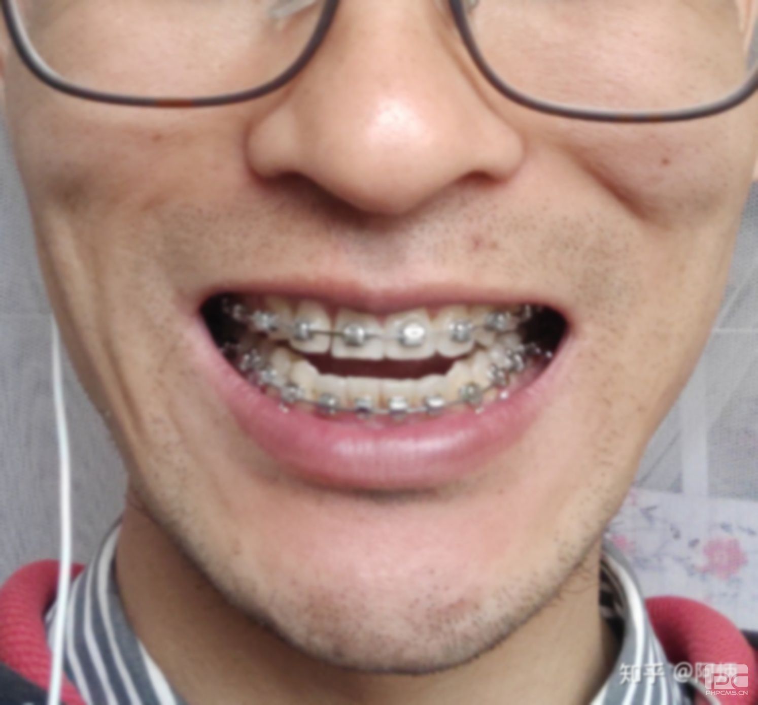牙齒矯正 35歲,35歲牙齒矯正要多久,35歲牙齒矯正一般需要多少時(shí)間? 牙齒矯正 35歲,35歲牙齒矯正要多久,35歲牙齒矯正一般需要多少時(shí)間?