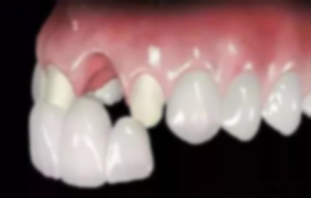 烤瓷牙能不能磨小,能磨小一点吗?可以磨小吗? 烤瓷牙能不能磨小,能磨小一点吗?可以磨小吗?