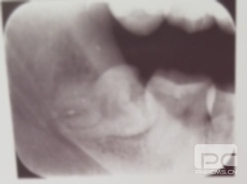 為什么不同醫(yī)院拔智齒費(fèi)用差那么多?醫(yī)院拔智齒為什么那么貴?什么醫(yī)院拔智齒最便宜?? 為什么不同醫(yī)院拔智齒費(fèi)用差那么多?醫(yī)院拔智齒為什么那么貴?什么醫(yī)院拔智齒最便宜??