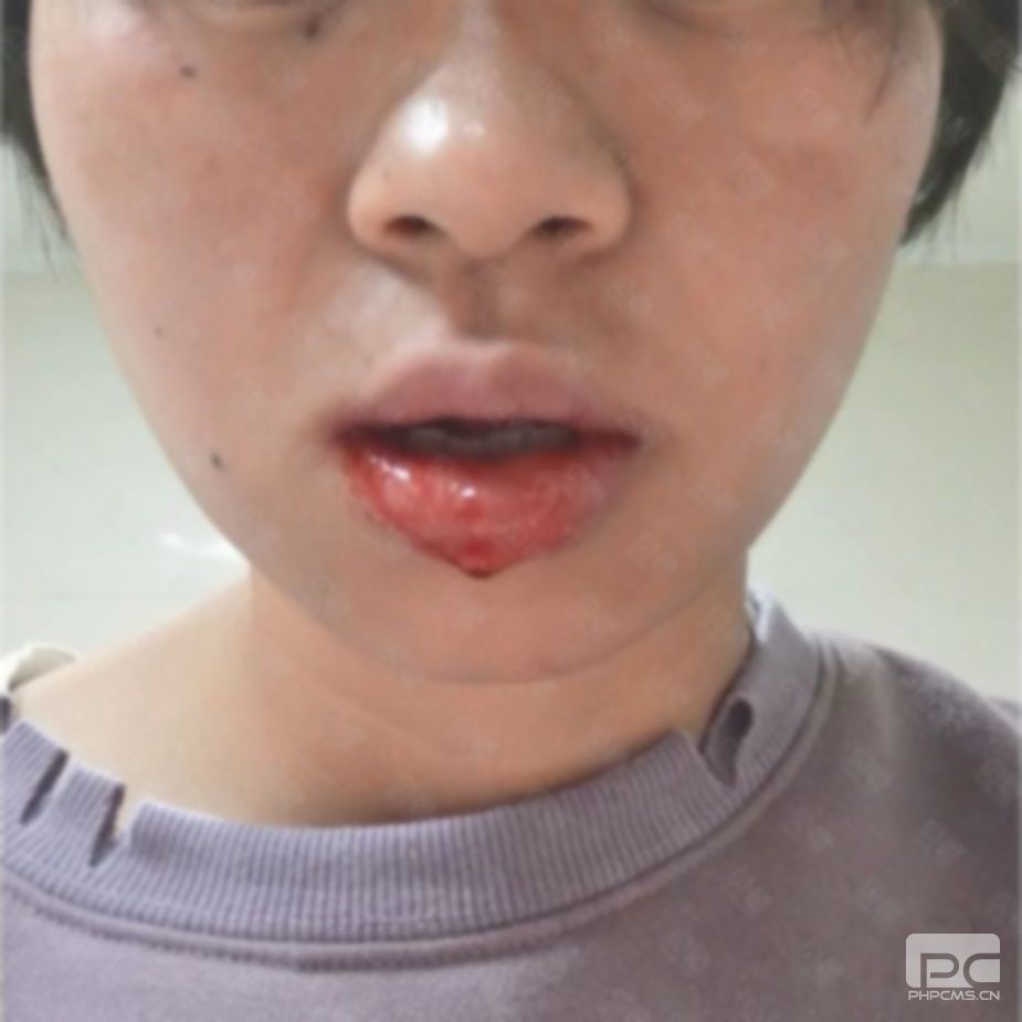 拔牙后半夜?jié)M嘴血塊,血流不止,怎么辦?嘴里的血塊能吐嗎? 拔牙后半夜?jié)M嘴血塊,血流不止,怎么辦?嘴里的血塊能吐嗎?
