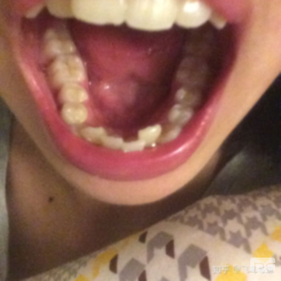8歲門牙突出又大怎么辦才好??小孩門牙外凸怎么辦??孩子門牙前突怎么改善? 8歲門牙突出又大怎么辦才好??小孩門牙外凸怎么辦??孩子門牙前突怎么改善?