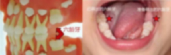 八歲小孩牙長歪怎么辦?孩子大牙長歪了怎么辦?8歲小女孩牙齒長歪了怎么辦? 八歲小孩牙長歪怎么辦?孩子大牙長歪了怎么辦?8歲小女孩牙齒長歪了怎么辦?
