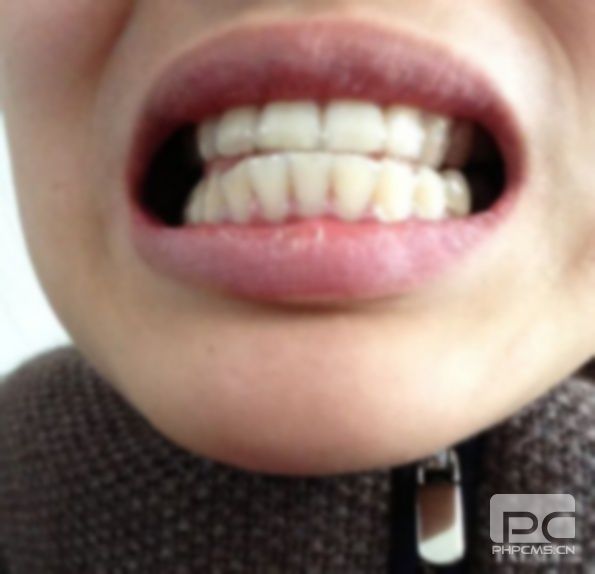 牙缝带牙套1~12月变化图,拔牙带牙套1~12月变化图,牙齿前突带牙套1~12月变化图