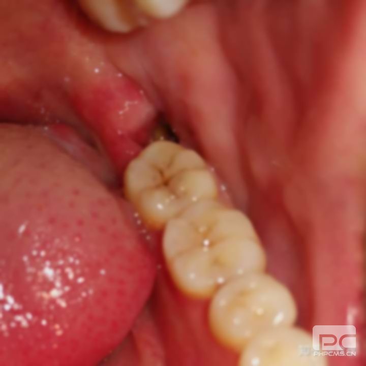拔智齒第三天是高峰期第二天不痛第三天會痛,怎么辦?什么意思? 拔智齒第三天是高峰期第二天不痛第三天會痛,怎么辦?什么意思?