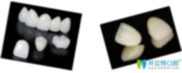 愛爾創(chuàng)全瓷牙價(jià),出廠價(jià)格,多少錢? 愛爾創(chuàng)全瓷牙價(jià),出廠價(jià)格,多少錢?