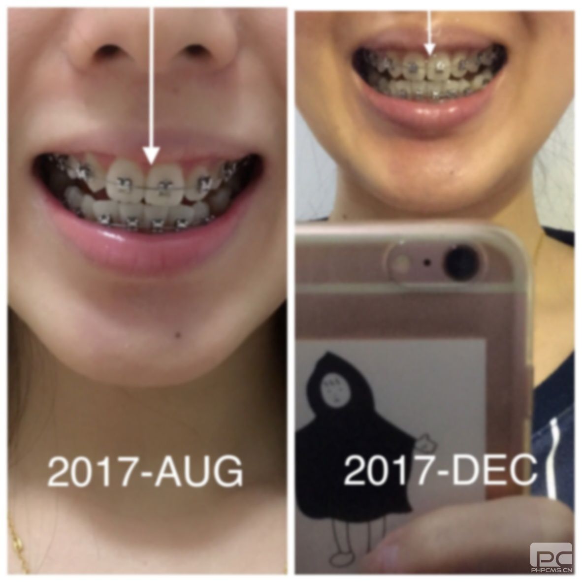 30歲戴牙套矯正牙齒需要多長時間,還能矯正嗎?后悔