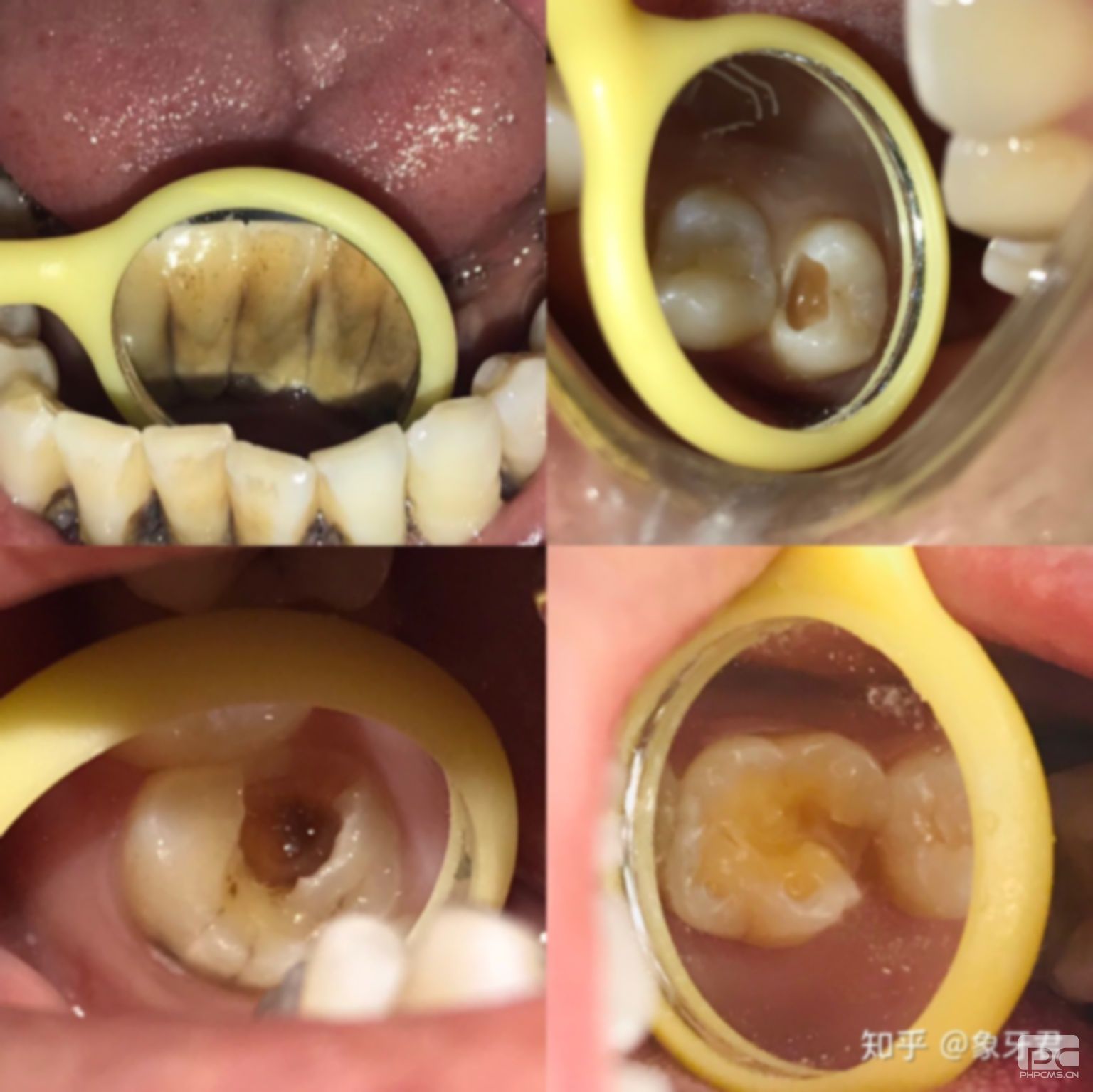拔蛀牙多少錢一個?齒多少錢一顆?大概多少錢?