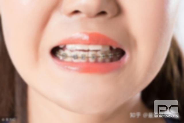 31歲還能矯正牙齒嗎,后期會(huì)造成牙齒松動(dòng)嗎?貴嗎??? 31歲還能矯正牙齒嗎,后期會(huì)造成牙齒松動(dòng)嗎?貴嗎???