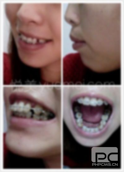28歲整牙齒對以后有影響嘛,可以整牙影響大嗎?整牙對牙齒有影響嗎? 28歲整牙齒對以后有影響嘛,可以整牙影響大嗎?整牙對牙齒有影響嗎?