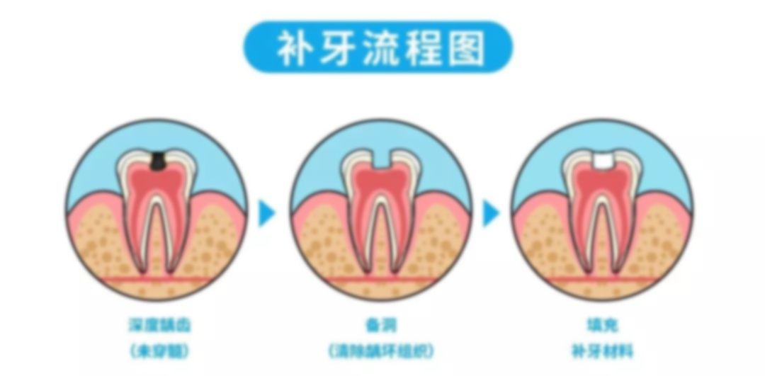 6歲蛀牙洞千萬(wàn)不能補(bǔ),4歲蛀牙洞千萬(wàn)不能補(bǔ),5歲兒童蛀牙洞千萬(wàn)不能補(bǔ) 6歲蛀牙洞千萬(wàn)不能補(bǔ),4歲蛀牙洞千萬(wàn)不能補(bǔ),5歲兒童蛀牙洞千萬(wàn)不能補(bǔ)