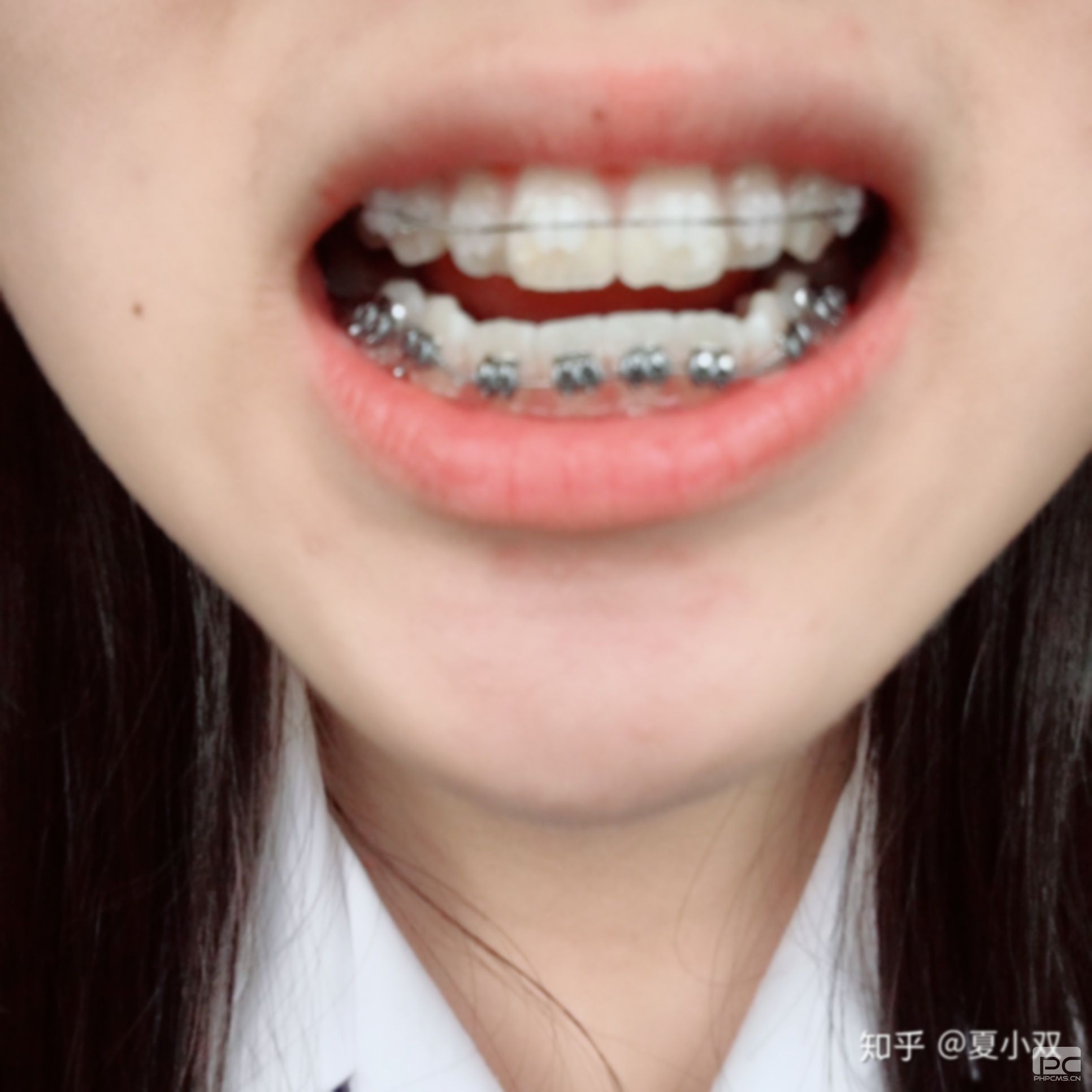拔完牙多久能戴牙套,后多久能戴牙套,牙后多久能戴牙套