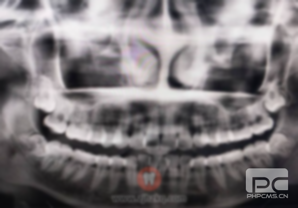 拔智齿埋伏牙多少钱?个埋伏牙要多少钱?埋伏多生牙多少钱?