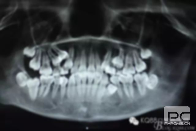多生牙拔牙多少钱?拔埋伏多生牙多少钱?埋伏牙拔除多少钱?