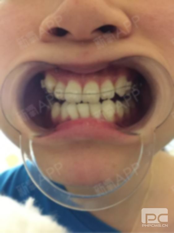 9歲牙齒矯正好嗎?九歲牙齒矯正可以嗎?能矯正牙齒嗎? 9歲牙齒矯正好嗎?九歲牙齒矯正可以嗎?能矯正牙齒嗎?