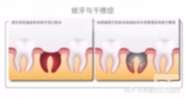 拔牙7天了還隱隱作痛我可出外玩嗎??可以輸液嗎?正常嗎? 拔牙7天了還隱隱作痛我可出外玩嗎??可以輸液嗎?正常嗎?