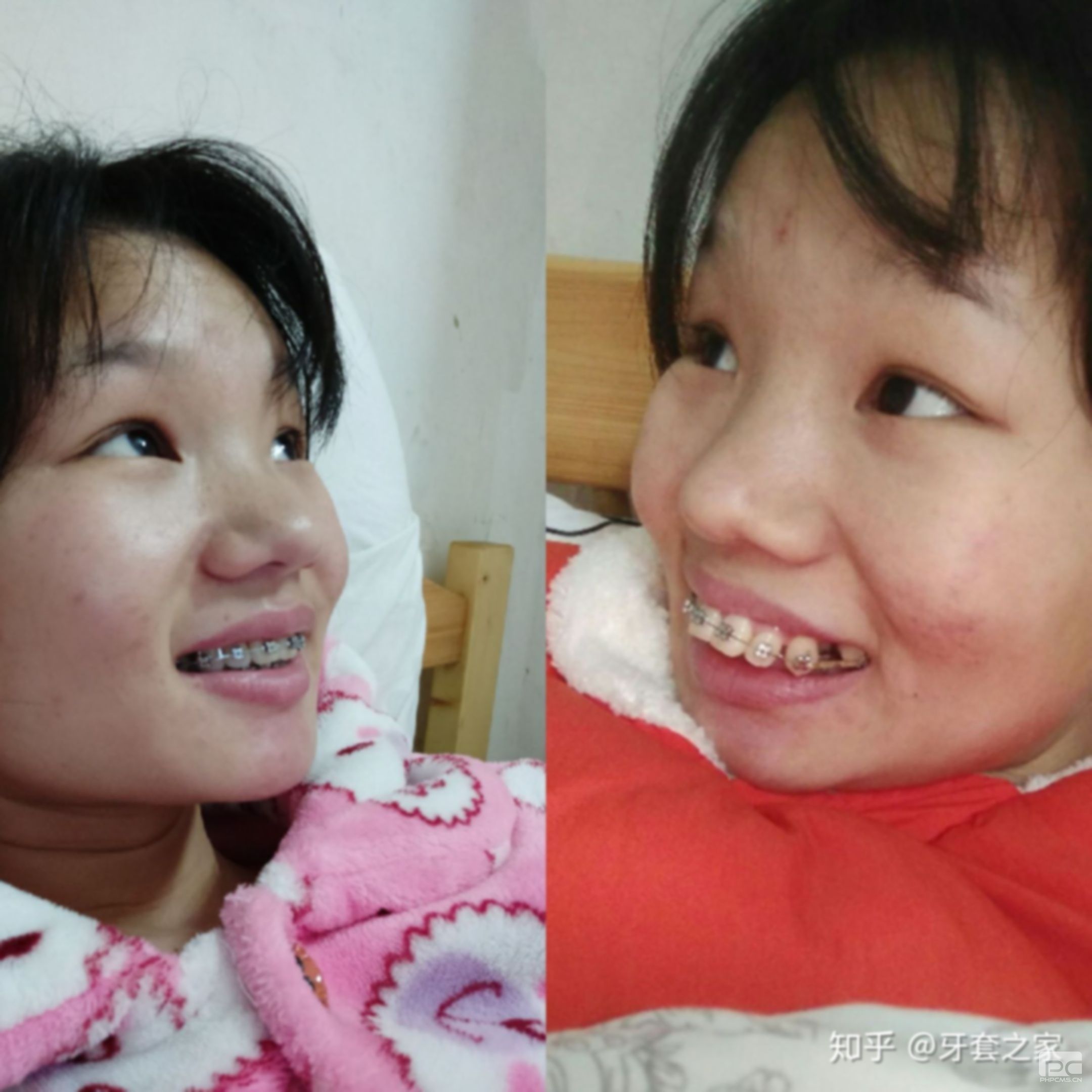 龅牙矫正怎么样不拔牙?能不能不拔牙,不拔牙的后果