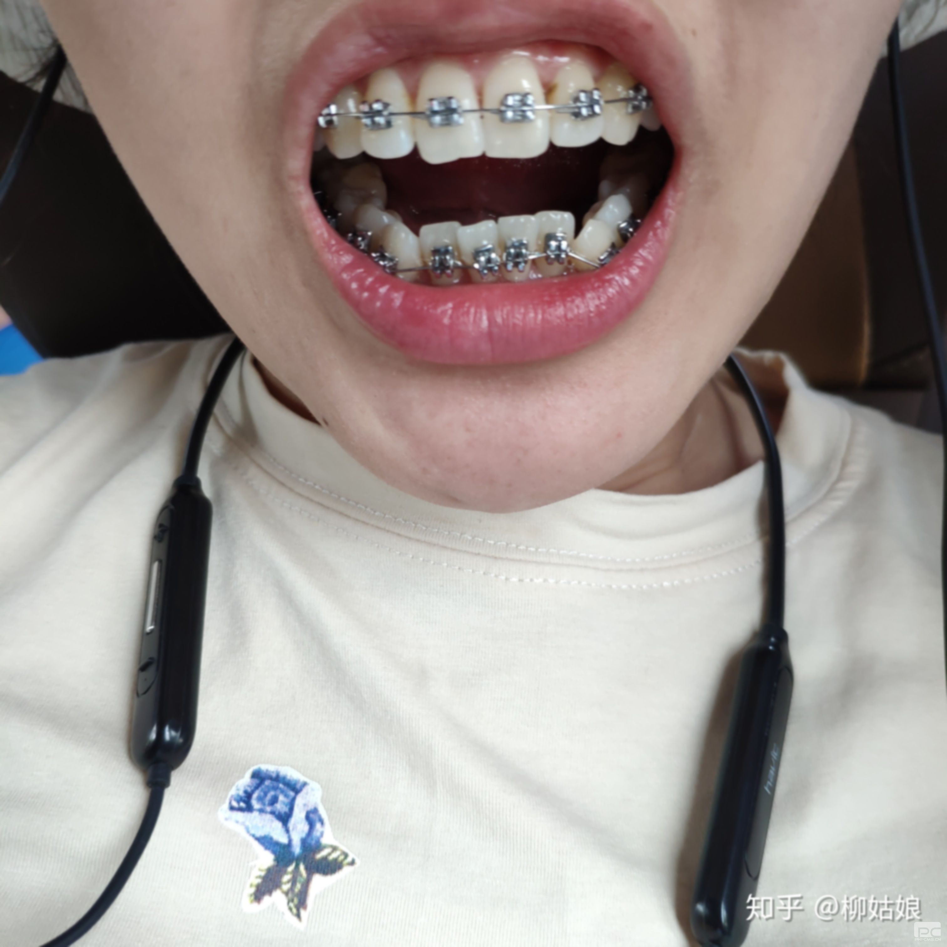 齙牙用牙套能改過來嗎?牙齒有齙牙不戴牙套可以嗎?不帶牙套怎么恢復(fù)? 齙牙用牙套能改過來嗎?牙齒有齙牙不戴牙套可以嗎?不帶牙套怎么恢復(fù)?