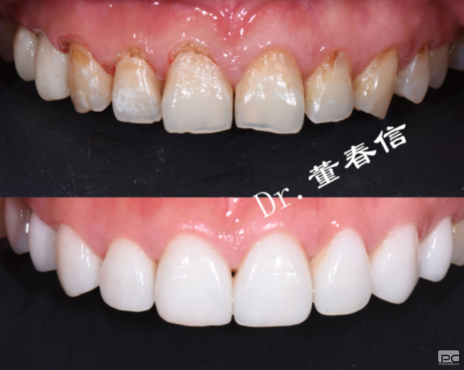 拔牙后嘴里的血塊能吐嗎?血塊要吐掉嗎?的血塊可以吐嗎? 拔牙后嘴里的血塊能吐嗎?血塊要吐掉嗎?的血塊可以吐嗎?