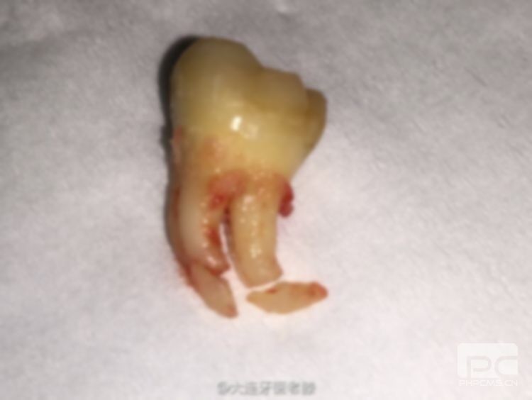 拔牙后的血凝块是什么样的图片?子?什么样子?