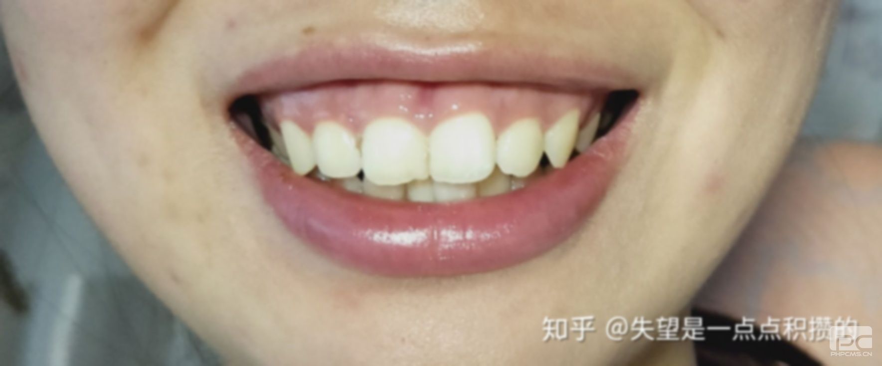 齙牙矯正不拔牙的后果,能不能不拔牙,怎么樣不拔牙? 齙牙矯正不拔牙的后果,能不能不拔牙,怎么樣不拔牙?