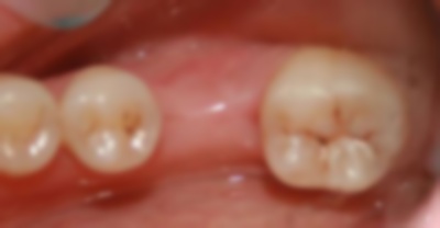 牙齒缺損一小塊需要修復嗎?怎么修復?怎么回事? 牙齒缺損一小塊需要修復嗎?怎么修復?怎么回事?