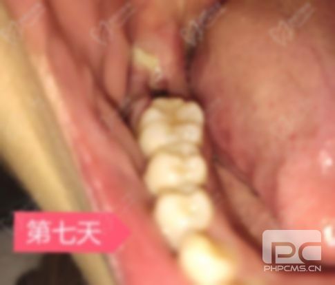 拔牙后牙洞恢復(fù)圖,過程圖,過程 拔牙后牙洞恢復(fù)圖,過程圖,過程