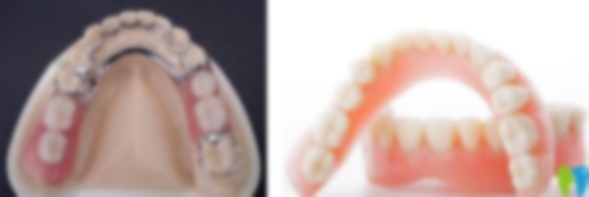 牙齒拔掉了,裝一顆假牙大概要多少錢呢?拔了裝假牙多少錢一顆?牙全拔了裝假牙多少錢? 牙齒拔掉了,裝一顆假牙大概要多少錢呢?拔了裝假牙多少錢一顆?牙全拔了裝假牙多少錢?