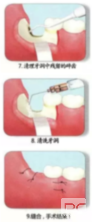 拔完牙拆線視頻,牙拆線視頻,牙拆線過程視頻 拔完牙拆線視頻,牙拆線視頻,牙拆線過程視頻