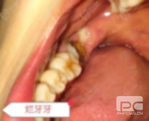 拔牙后牙洞恢復(fù)過程圖,,圖 拔牙后牙洞恢復(fù)過程圖,,圖