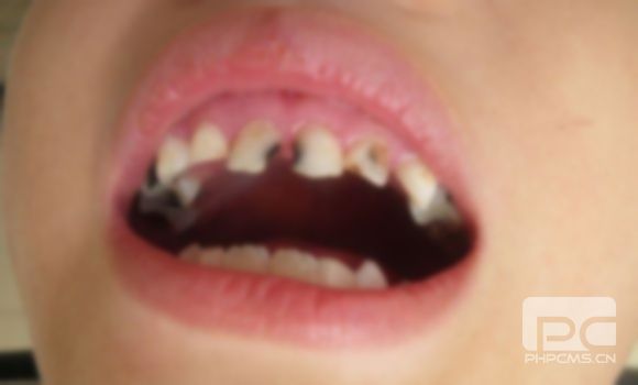 小孩牙有縫隙怎么回事?齒都有縫隙怎么回事?孩子的牙有縫隙是怎么回事? 小孩牙有縫隙怎么回事?齒都有縫隙怎么回事?孩子的牙有縫隙是怎么回事?
