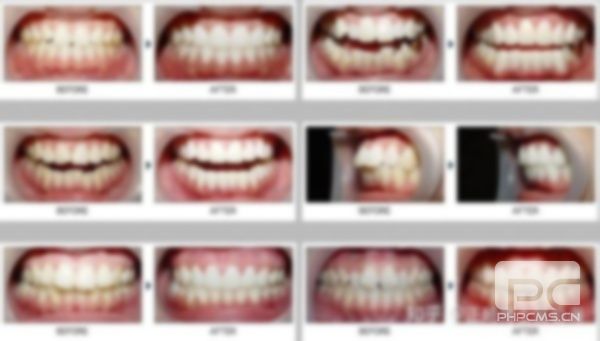 龅牙整牙后脸型变化,正畸牙齿后脸型变化图,矫正后侧脸变化